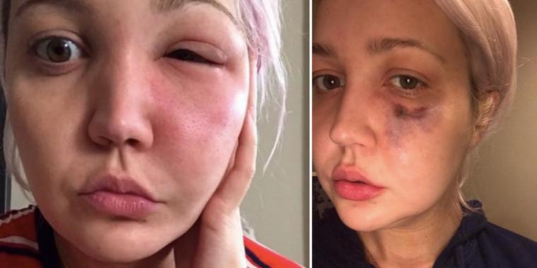 31-åring våknet opp med mystisk hevelse i øyet – så ble den skumle årsaken avslørt