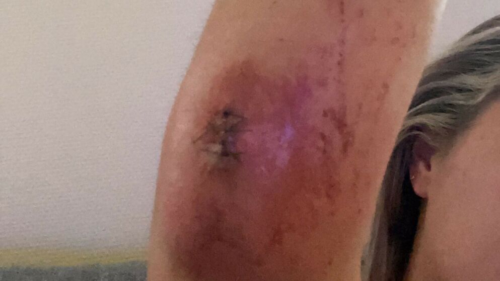 Angrepet av måker: Måtte sy