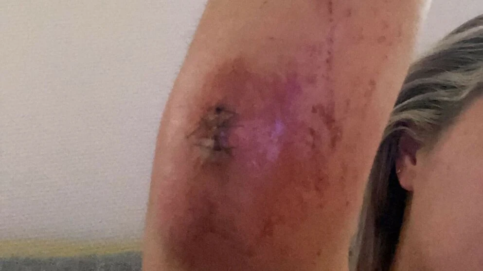 Angrepet av måker: Måtte sy