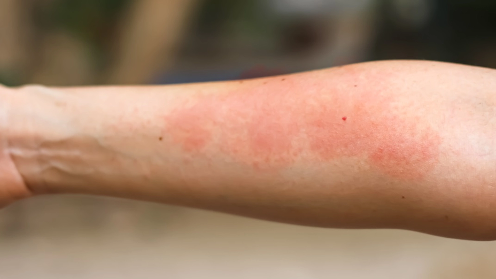 Ekspert advarer: Ikke plukk denne vanlige blomsten – gir smertefullt utslett