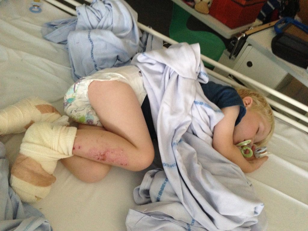 3-årige Jakob var nære å miste tærne på stranden – nå advarer moren hans Katja andre mødre