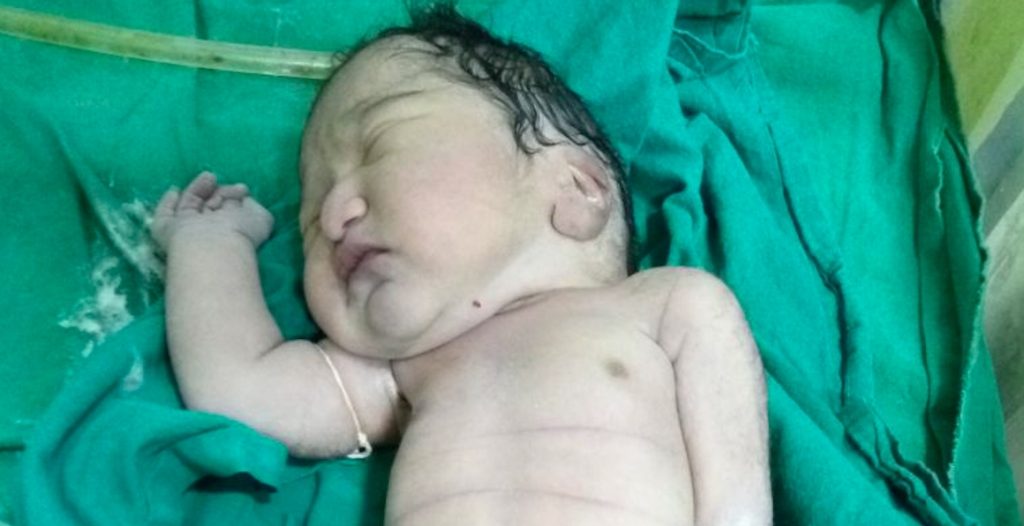 Etter en ganske spesiell fødsel: 23-årig kvinne forbløffer hele verden med havfrue-babyen sin