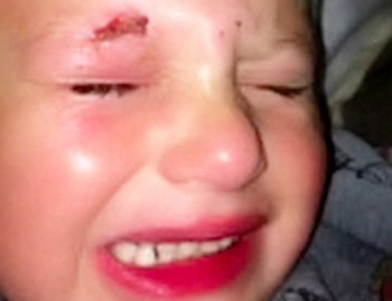 Helte lim i øyet på 4-åring: ‘Jeg holdt beina hans, mens moren hans holdt i armene’