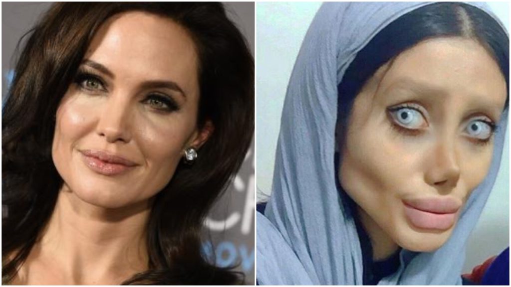 Kvinne ville se ut som Angelina Jolie – resultatet er skremmende