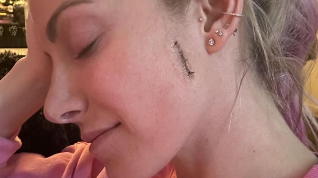 Star deler advarsel – rammet av hudkreft: ‘Husk å få det gjort!’