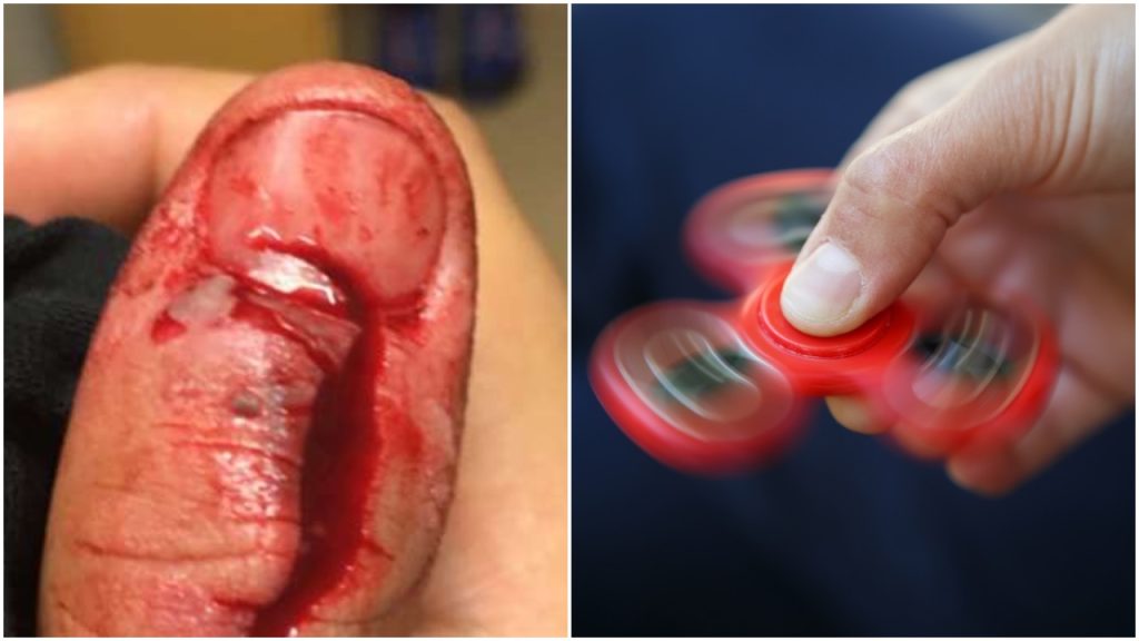 Alexanders fidget spinner eksploderte plutselig – nå advarer han andre
