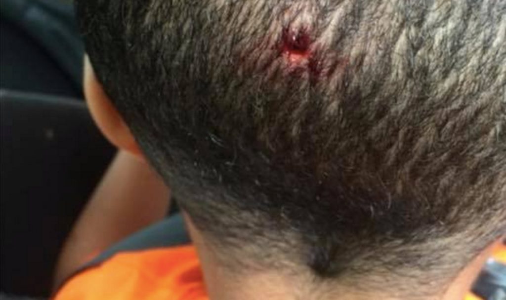 Mor finner 4-årig sønn med blodige merker overalt – så forteller en pedagog hva som skjedde