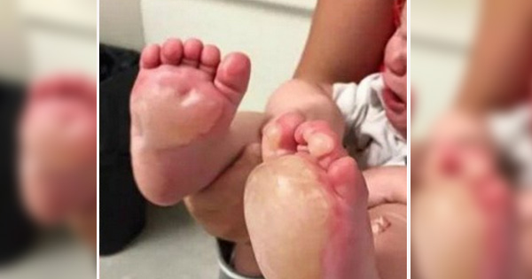 Mor kommer hjem og finner store blemmer på babyens føtter – så innser hun barnevaktens mørke hemmelighet
