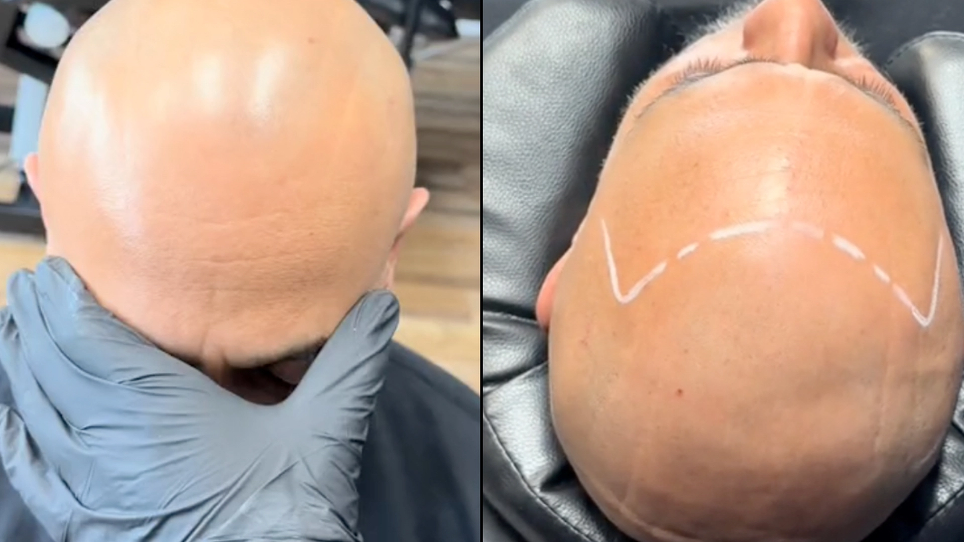 Mannen får tatovert «hår» på skallet hodet: Folk er i sjokk over resultatet