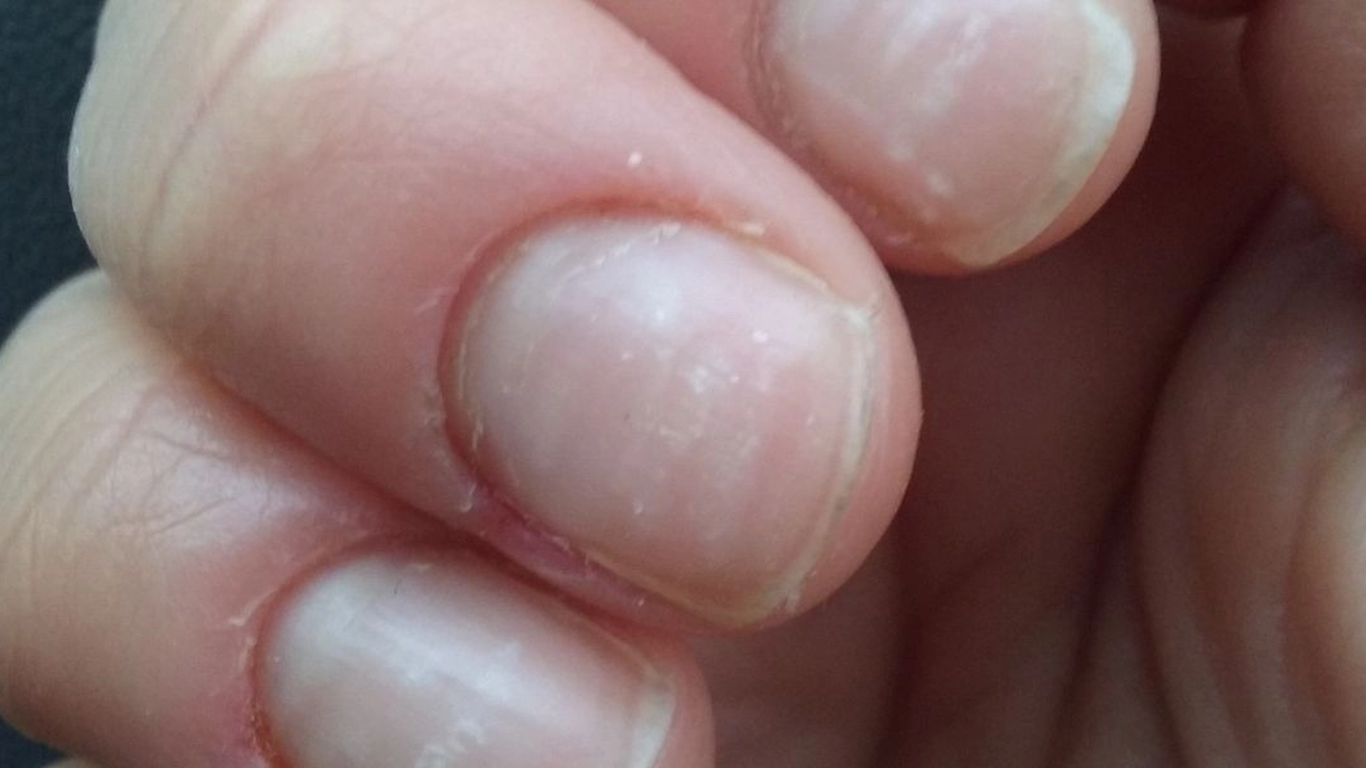 Hudlege avslører: Sannheten bak hvite flekker på neglene