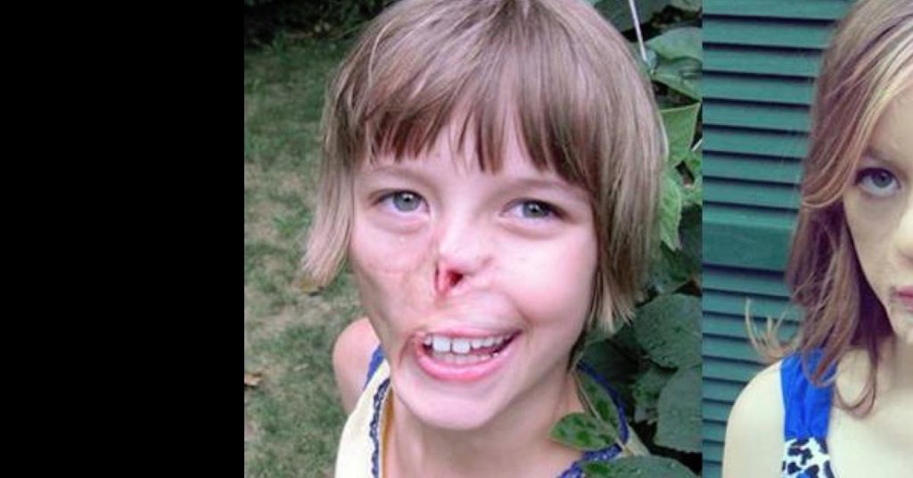 Charlotte var bare tre måneder gammel da halvparten av ansiktet hennes ble ‘spist’ vekk – 11 år senere tar livet hennes en dramatisk vending