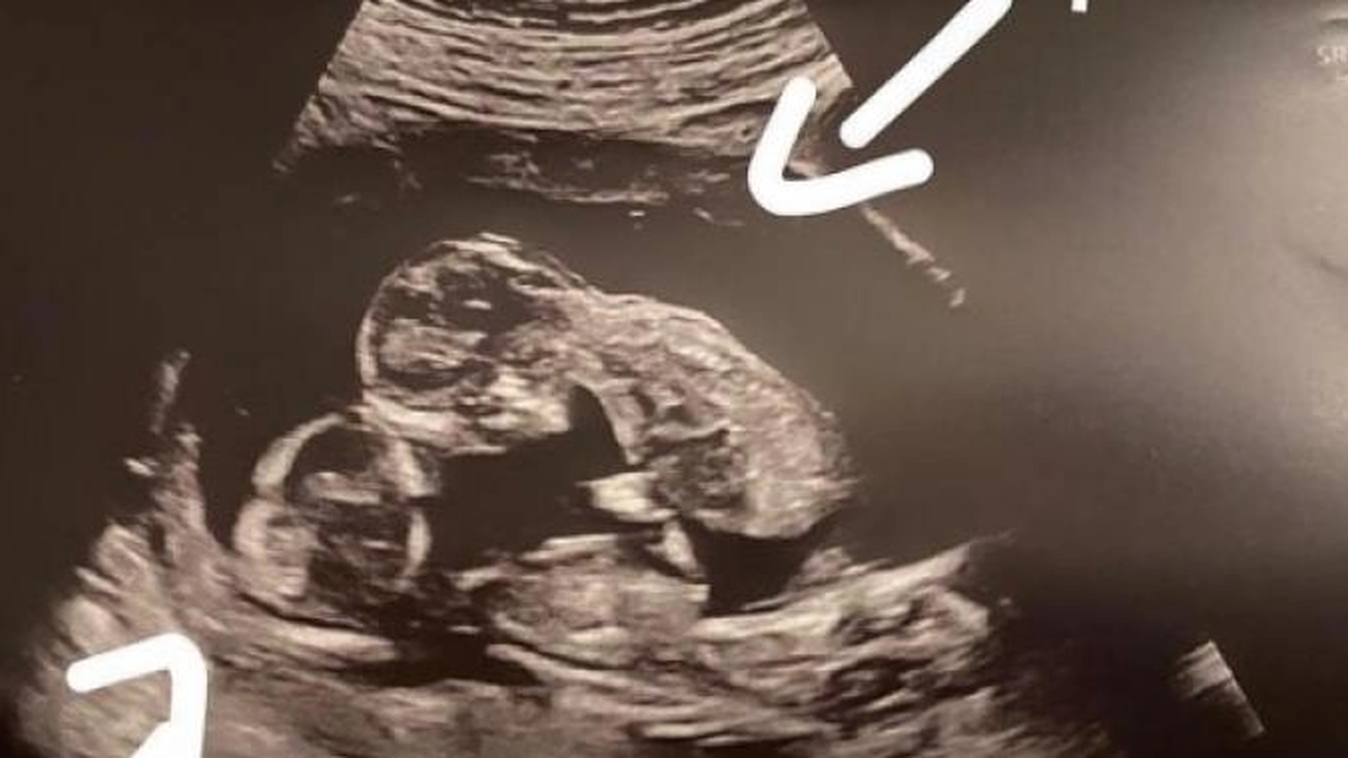 Var gravid med trillinger: Da oppdaget legene en unik detalj