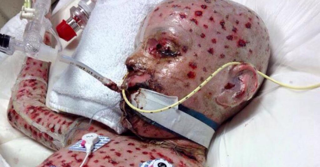 Legene trodde det var giftig eføy – men få dager senere begynner huden hans å falle av kroppen
