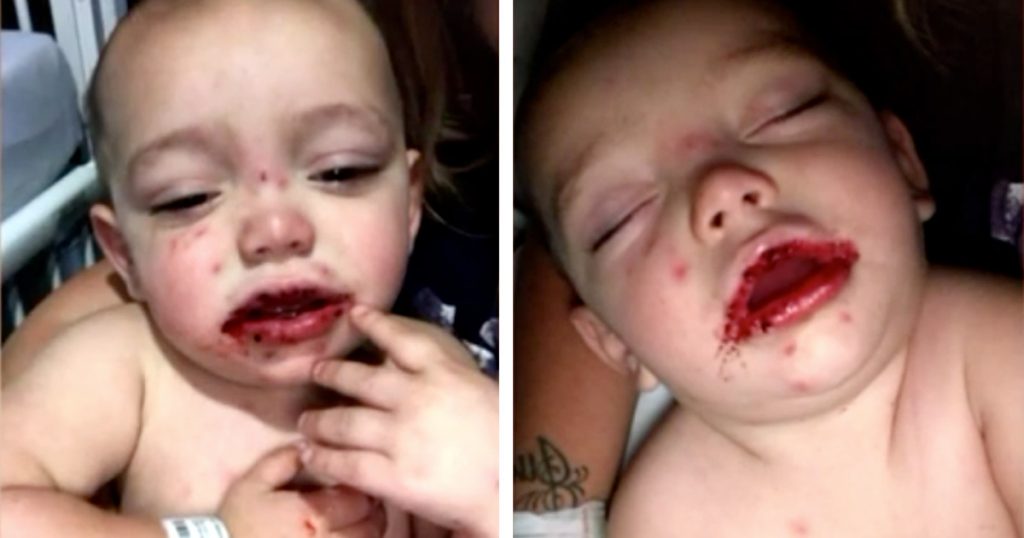 Mor oppdager blodige sår i munnen på 1-år gammel sønn – får panikk da hun ser nærmere etter