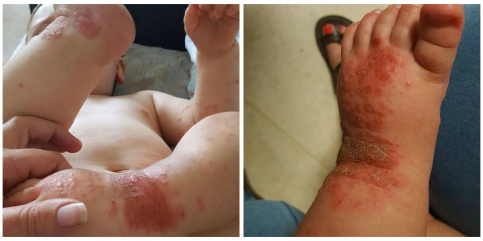 Mors skremmende bilder av sønnen Oliver går viralt: Tenk deg om, før du kysser en baby