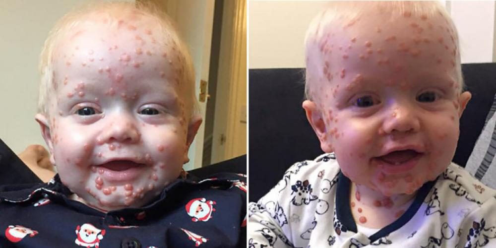 Trodde 4 år gamle Oscar hadde fått vannkopper: Viste seg å være mye verre