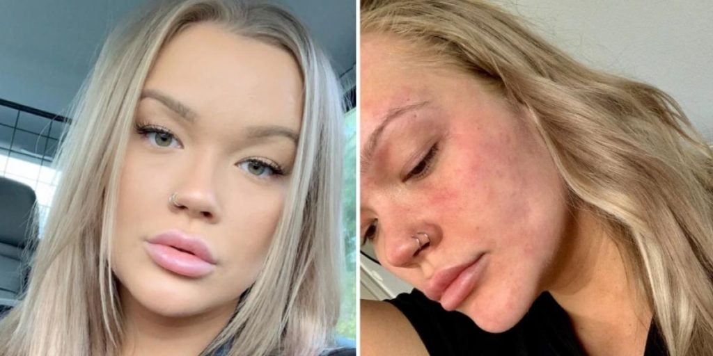 Isabella er allergisk mot vann: «Folk tror jeg lyver»