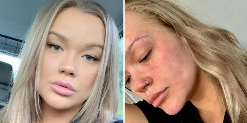 Isabella er allergisk mot vann: &laquo;Folk tror jeg lyver&raquo;