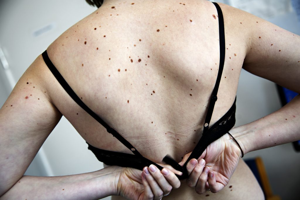 10 kreftsymptomer de fleste ignorerer
