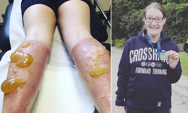 Julie oppdaget små blemmer på beinene etter en løpetur og skyndte seg på sykehuset – men de ble bare større og større