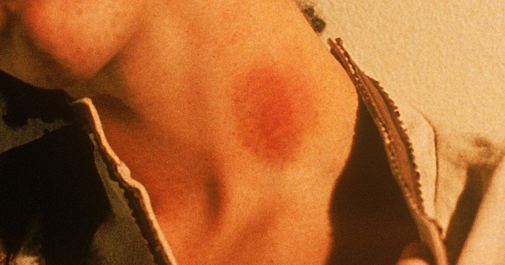 Hun ga tenåring-kjæresten sin et sugemerke på halsen – senere på kvelden falt han død om på grunn av slag