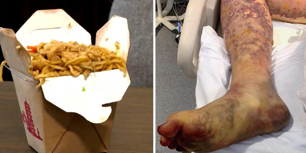 19-åring spiste rester av kinesisk takeaway: Nå har han mistet bein og fingrene