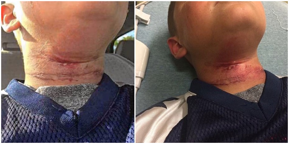 8-åring innlagt på sykehuset etter at en tenåring hang ham i et tre