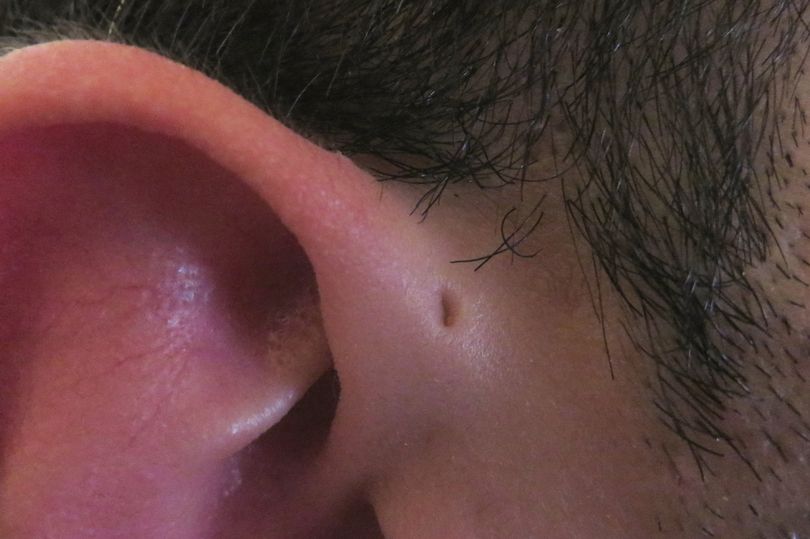 Forsker avslører: Derfor har noen mennesker bittesmå hull over ørene