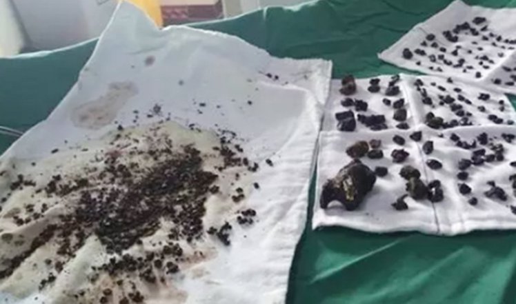 Legenes merkelige forklaring etter mystisk funn i kvinnes mage: ‘Du har ikke spist nok frokost’