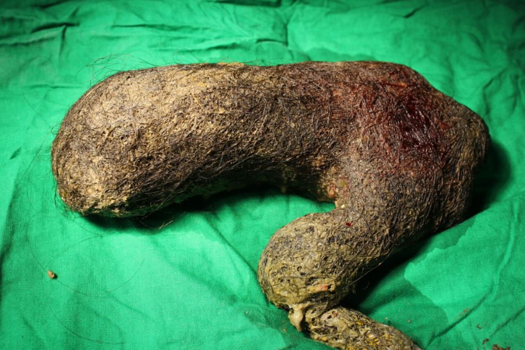 Ung kvinne klaget over smerter: Legene fant dette i magen hennes