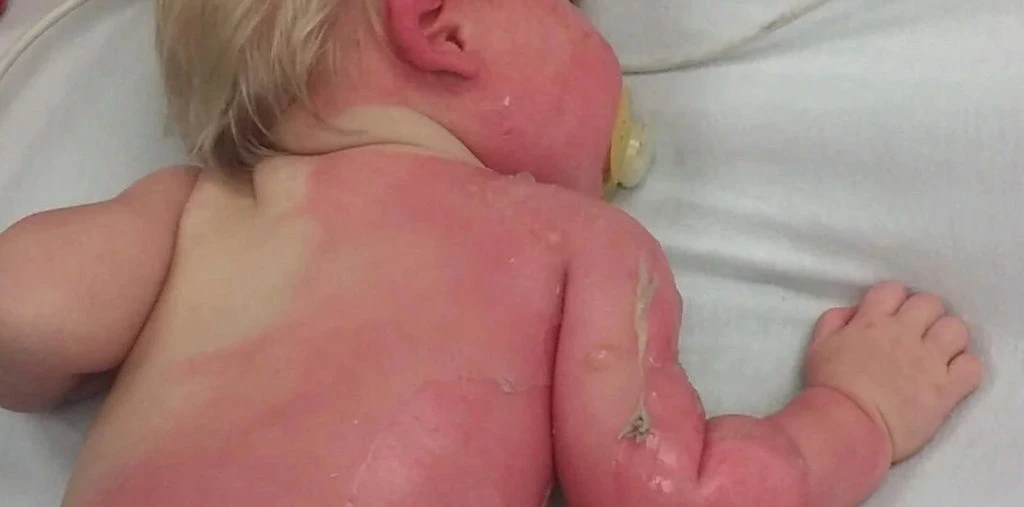 Mamma advarer: Baby fikk brannskader på 30 prosent av kroppen