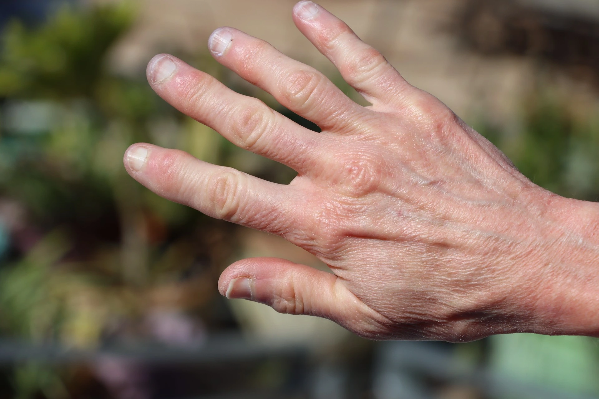 Leddgikt? Disse matvarene må du unngå
