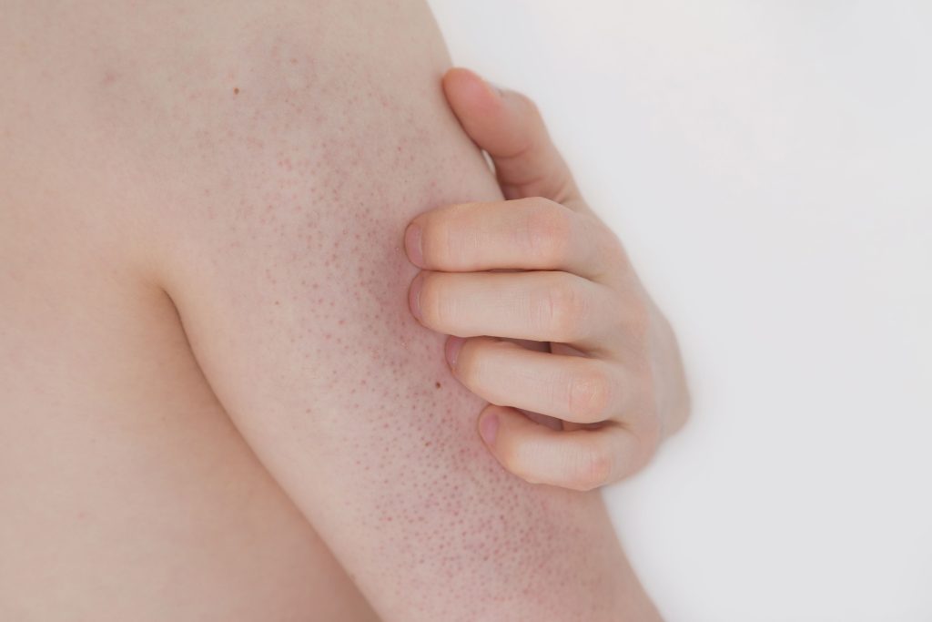 Har du slike nupper på huden? Da kan det være du har denne lidelsen