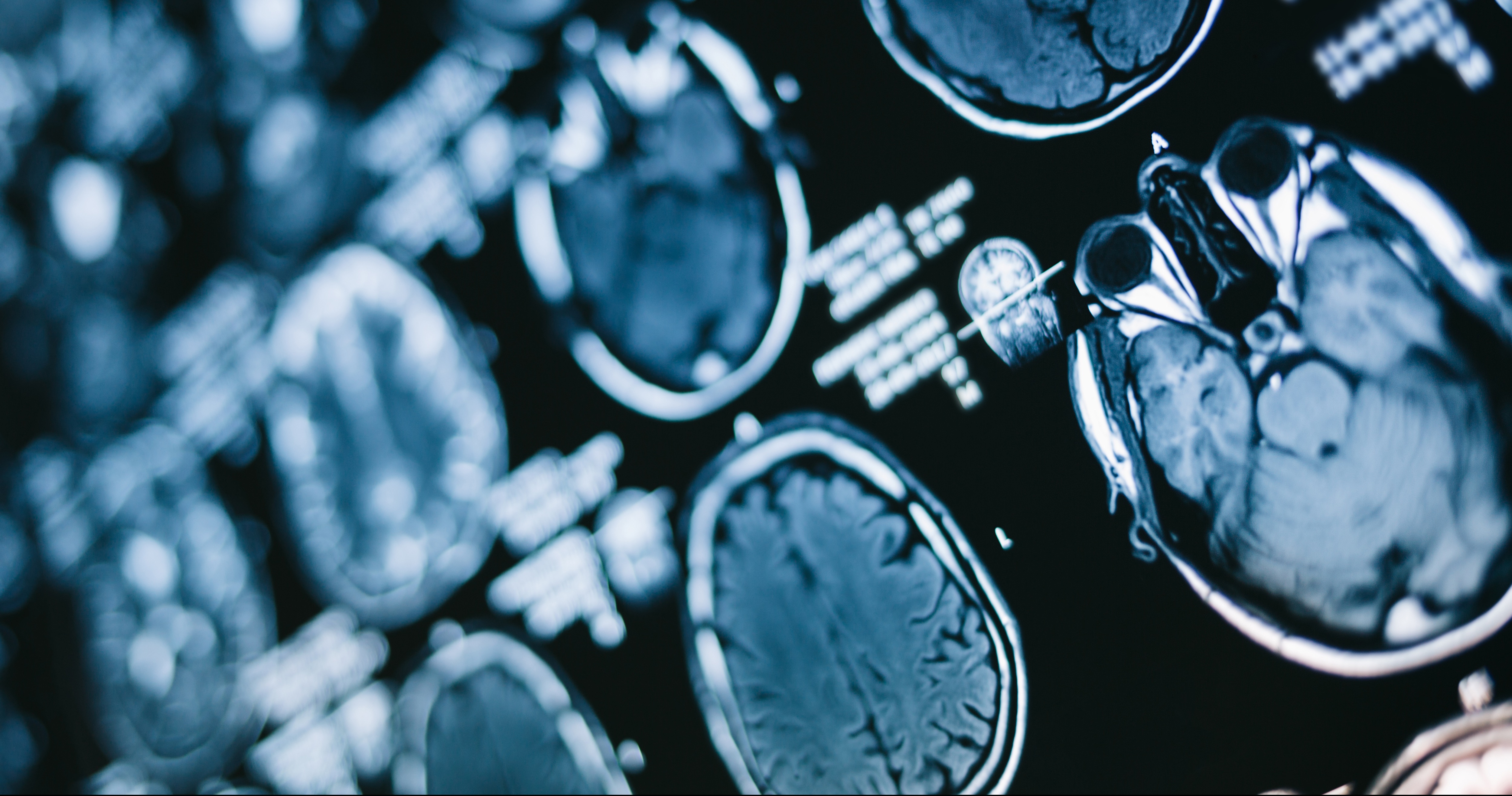 Endelige resultater bekrefter gode Alzheimers nyheter fra Novo-rival