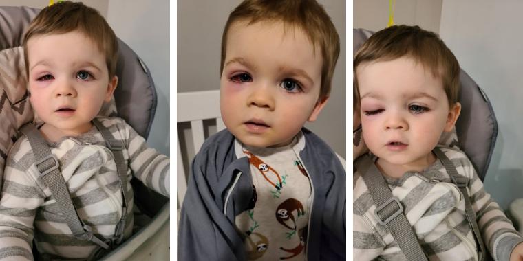 2 år gammel gutts øye svulmer opp til fordoblet størrelse: Nå advarer mammaen andre