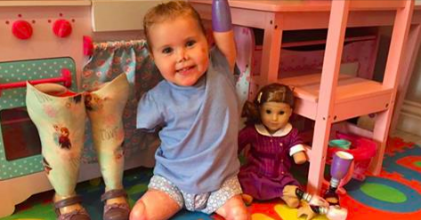 2-årig jente mistet lemmene sine til sjelden sykdom: Får en dukke med benproteser