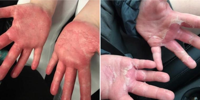 Ulykkelig mor advarer mot populær trend: «Min datters hud falt plutselig av»
