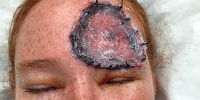 39 år gammel mor fikk en liten flekk på pannen – hadde ingen anelse om at hun var i livsfare