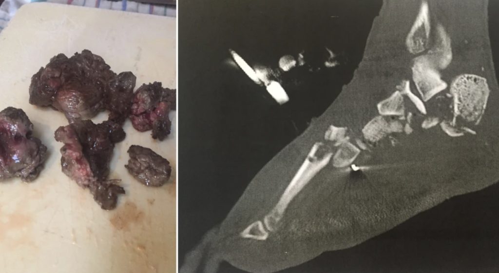 Mann serverte vennene sine tacos som var laget av hans eget amputerte ben