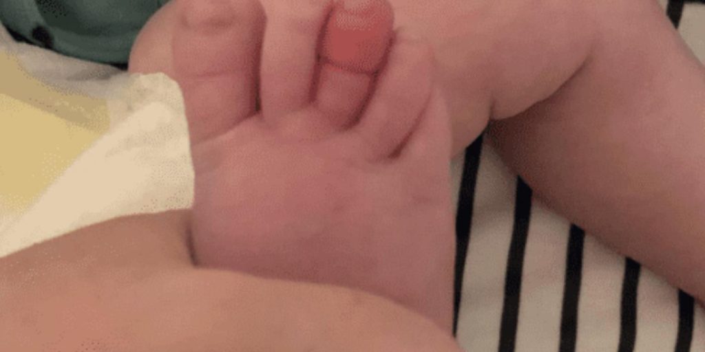 Mor varsler foreldre: Hårstrå kostet nesten 5 måneder gammel baby tåen