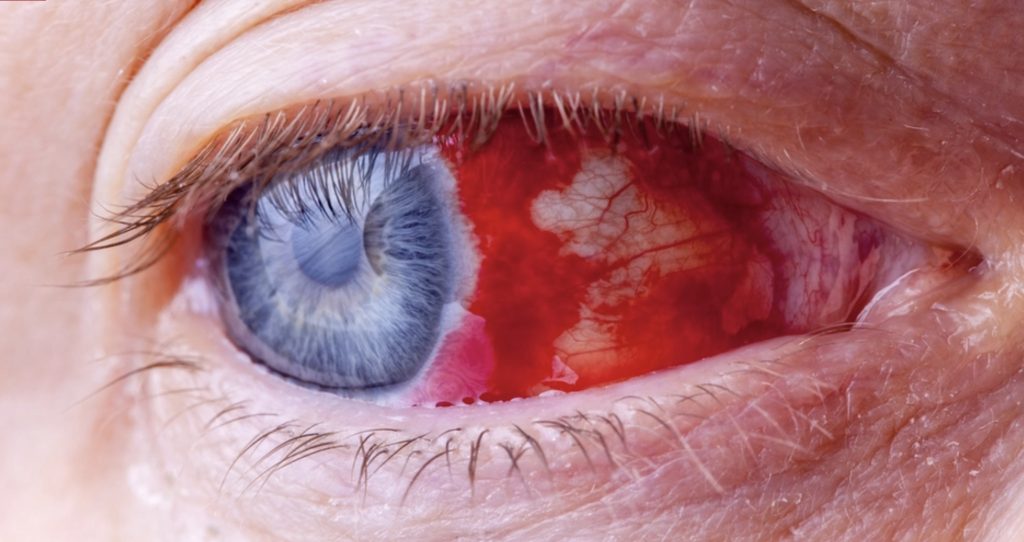 Viral virus: Dødelig øyeblødningsvirus funnet i Spania