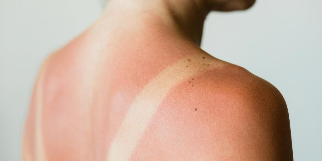 Sånn oppholder du deg riktig i solen