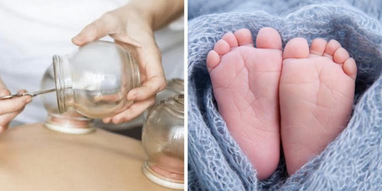 Folk raser over bilde av 3 måneder gammel baby som får sugekoppbehandling