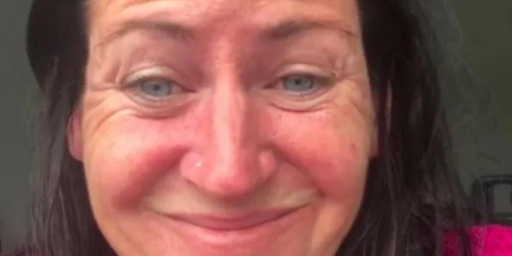 Kvinne tar botox for første gang: Folk tror ikke at det er samme person