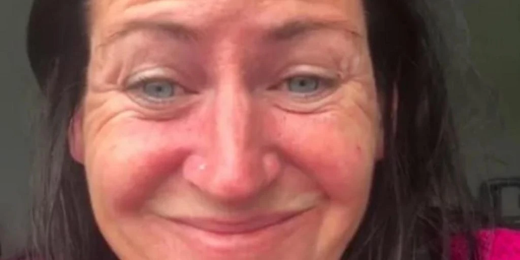 Kvinne tar botox for første gang: Folk tror ikke at det er samme person