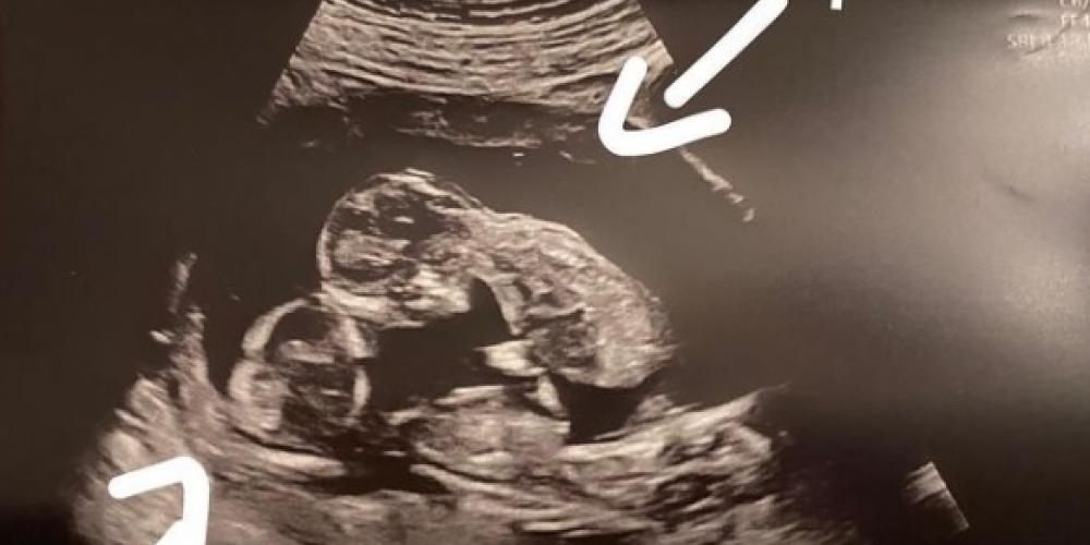 Var gravid med trillinger: Da oppdaget legene en unik detalje
